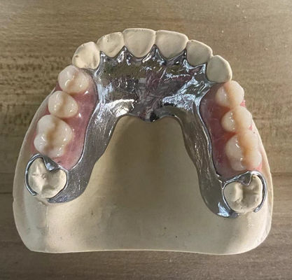 Высокопрочные литые металлические частичные протезы с 3D-печатью